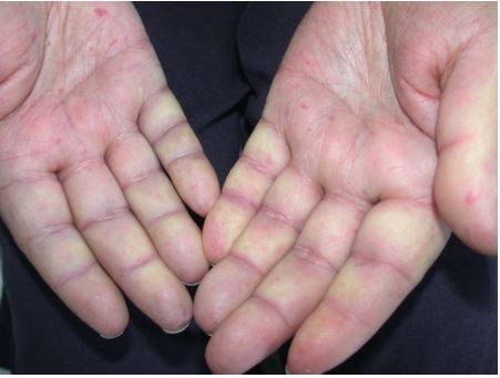 Acrosyndrome vasculaire