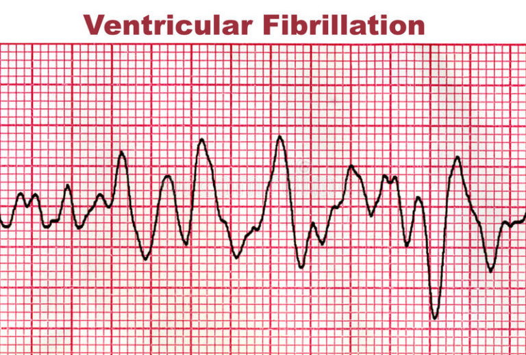 Fibrillation Ventriculaire
