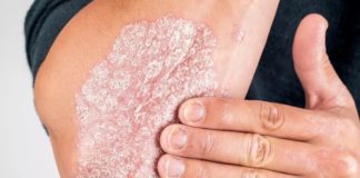 Psoriasis coude